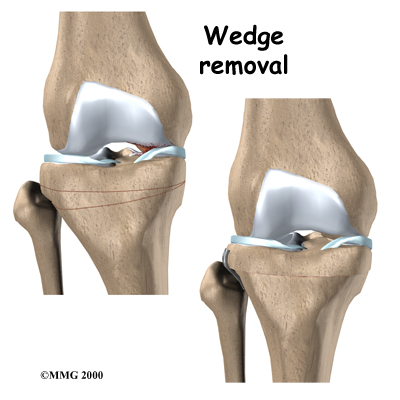 Osteoarthritis of the Knee - Paul Kiritsis, MD - Richmond, VA Premier ...