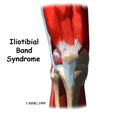 Anatomical depiction of the Iliotibial Band Syndrome and Treatment in Midlothian, VA