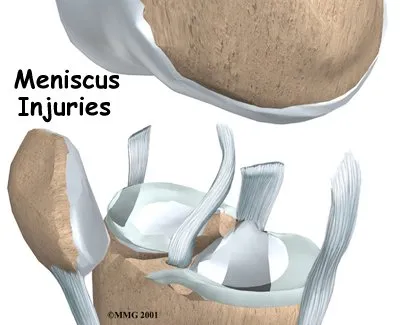 Anatomical graphic of meniscus injuries and tears.