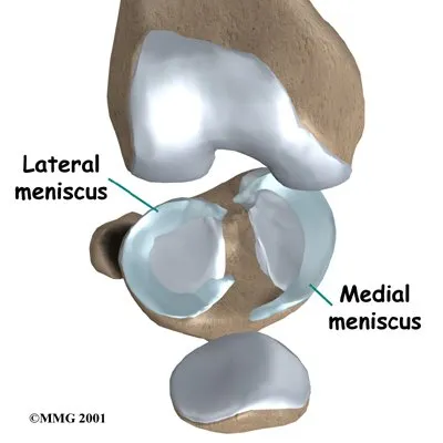 Anatomical graphic of the inside of the knee and showing meniscus surgery.