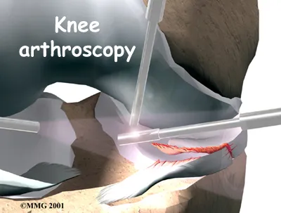 Dr. Kiritsis uses an arthroscope during surgery for an injured meniscus.