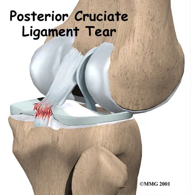 Anatomic graphic of Posterior Cruciate Ligament Injuries or tears that require treatment.