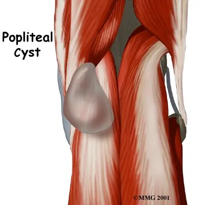 An anatomic graphic of a Popliteal Cysts and can be treated in Midlothian, VA.