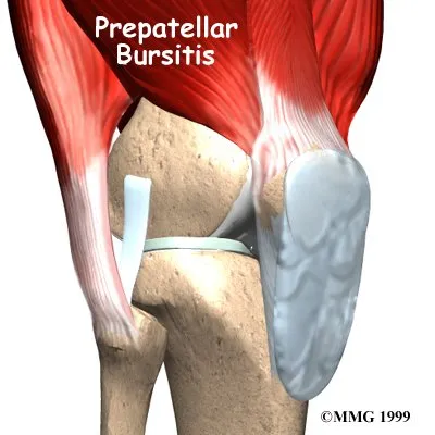 Anatomical graphic of what prepatellar bursitis looks when inflamed