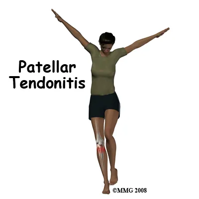 The women in the picture jumping on her knee can cause Patellar Tendonitis