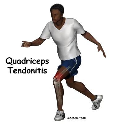 Anatomical graphic of what can happen to a patient when they have quadriceps-tendonitis
