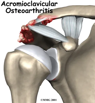 Anatomical graphic of the acromioclavicular joint being affected by osteoarthritis