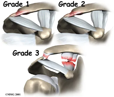Anatomical graphic of the three grades of Acromioclavicular Joint Separation