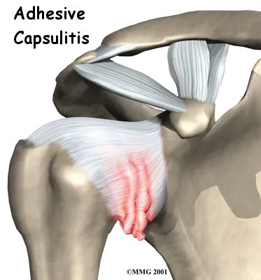 Anatomical graphic displaying where Adhesive Capsulitis affects the shoulder and is defined by the red marks.