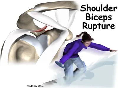 Anatomical graphic of the shoulder and how a woman snowboarding could get a shoulder bicep rupture