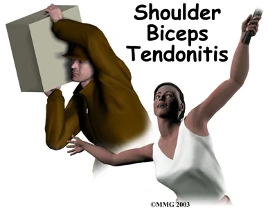 Graphic showing various ways people can overuse their shoulder and cause Biceps Tendonitis