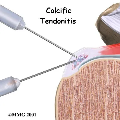 Anatomical graphic of treatment for calcific tendonitis of the shoulder