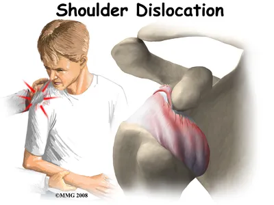 A man is getting hit in the shoulder which causes him to have a shoulder dislocation. Anatomical view of the dislocated shoulder.
