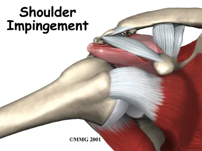 Anatomic graphic of a shoulder impingement