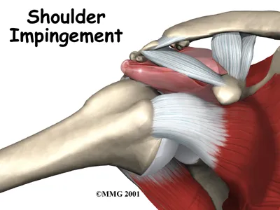 Impingement Syndrome - Paul Kiritsis, MD - Richmond, VA Premier Orthopedic  Surgeon