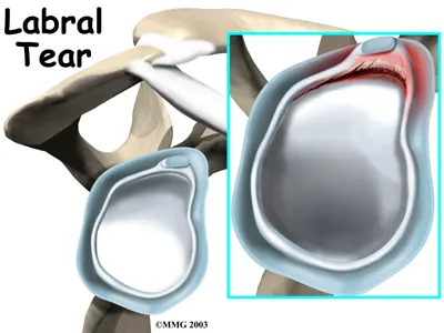 Anatomical graphic of a labral tear and where on the shoulder it causes discomfort or pain