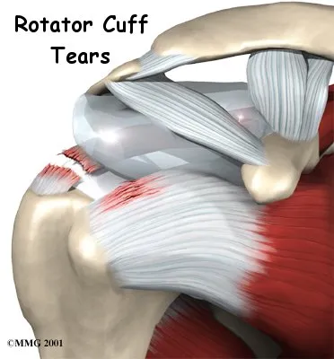Anatomical graphic of how a rotator cuff tears