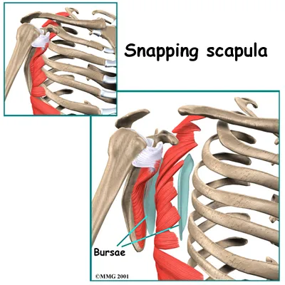 Anatomical graphic of the anatomy of Snapping Scapula Syndrome