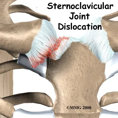 Anatomical graphic of a Sternoclavicular Joint Problem/dislocation