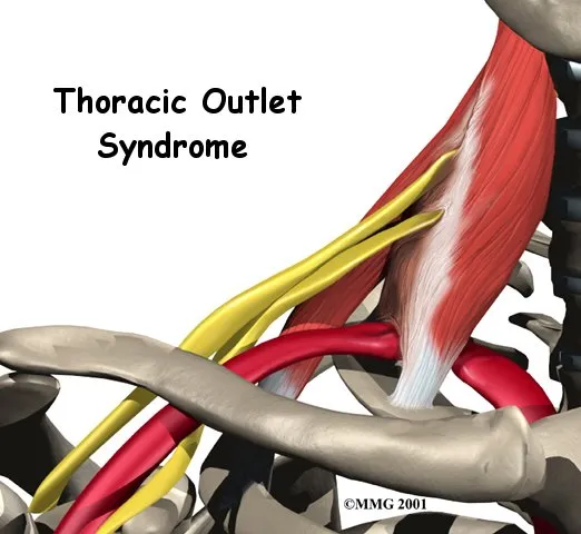 Anatomical graphic of Thoracic Outlet Syndrome