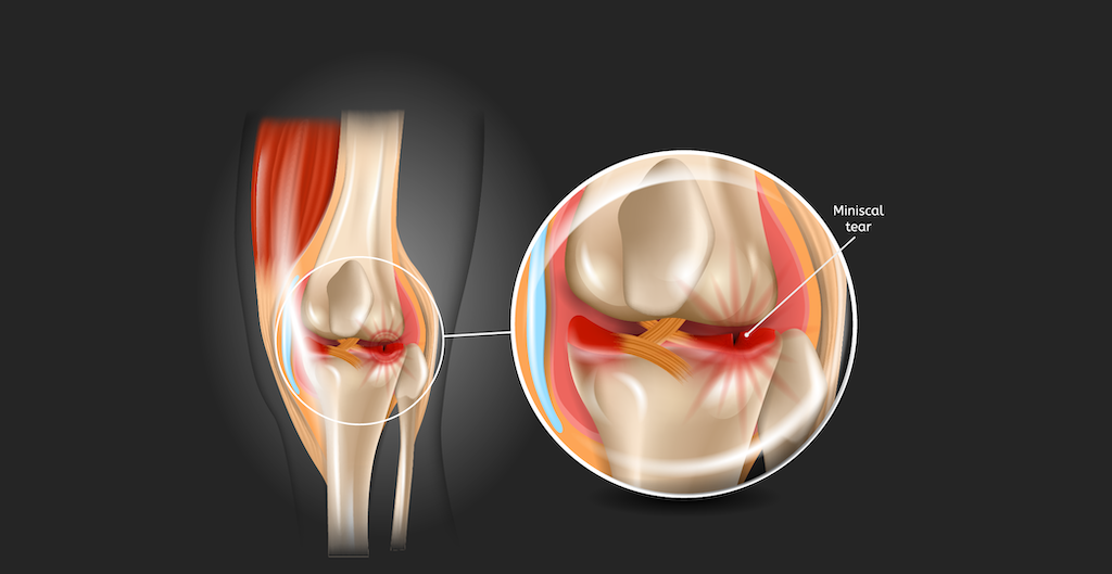 Can a Meniscus Tear Heal on Its Own Without Surgery?