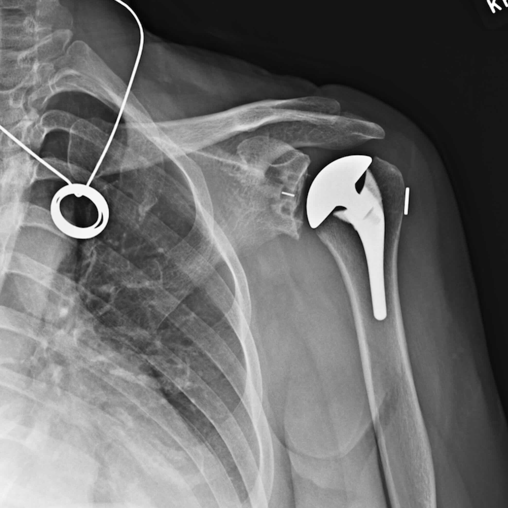 Precision Shoulder X-ray Case Library 01 | Cynthia B.