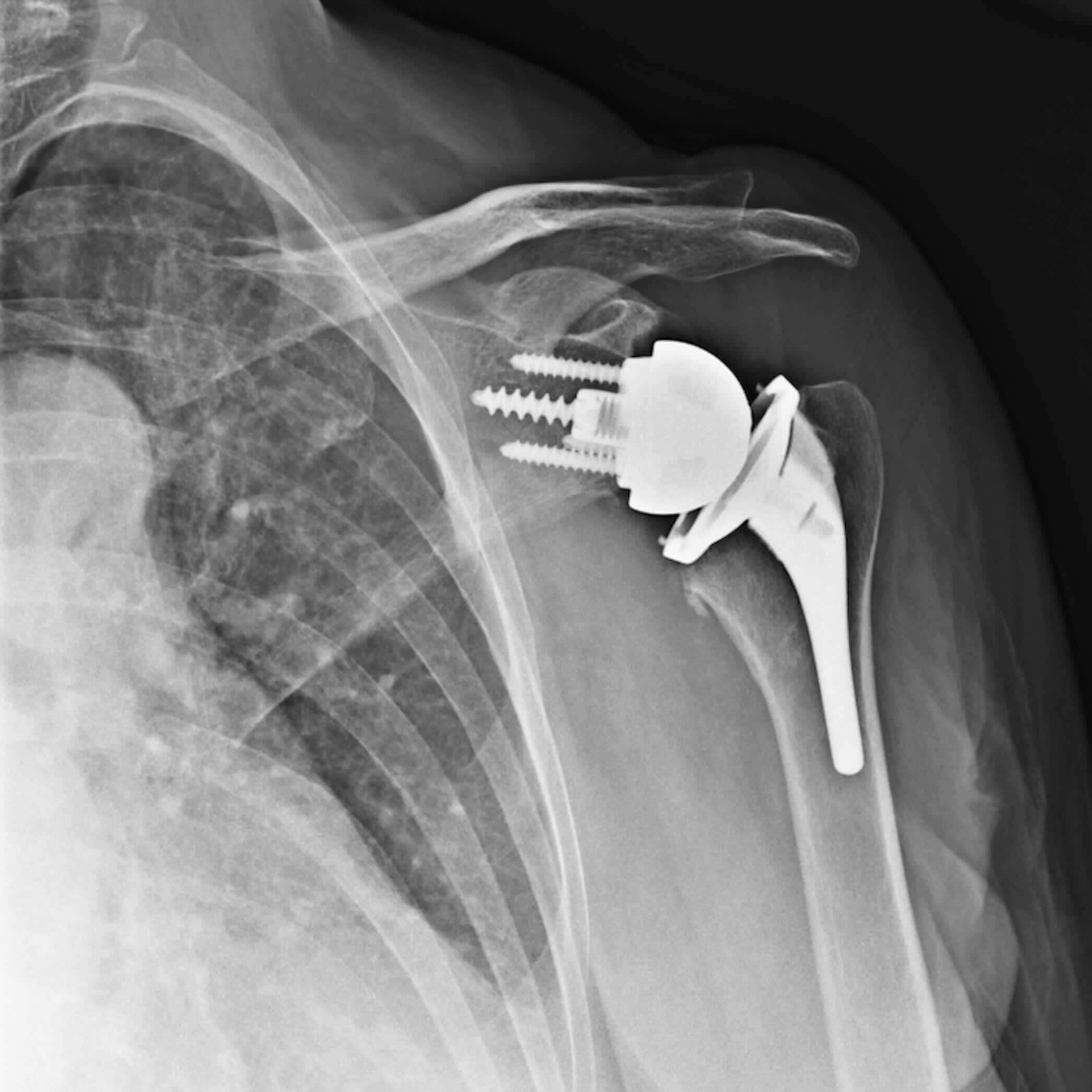 Precision Shoulder X-ray Case Library 03