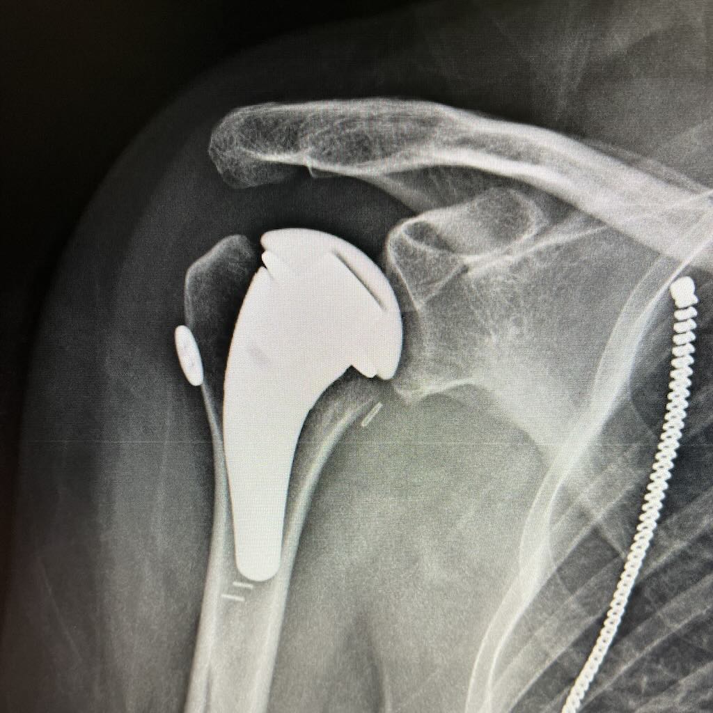 Precision Shoulder X-ray Case Library 36