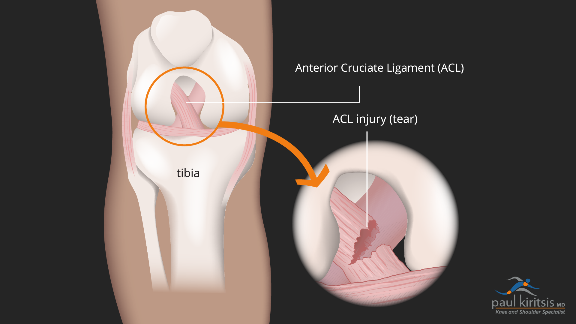 ACL Tear and Injuries might leave you wondering on whether or not you can walk. 