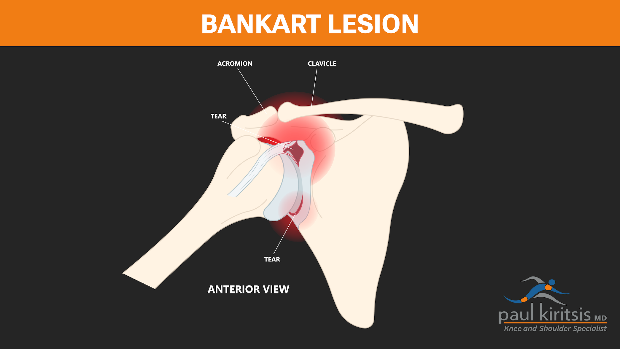 Bankart Reconstruction Relieving Shoulder Instability Paul Kiritsis 