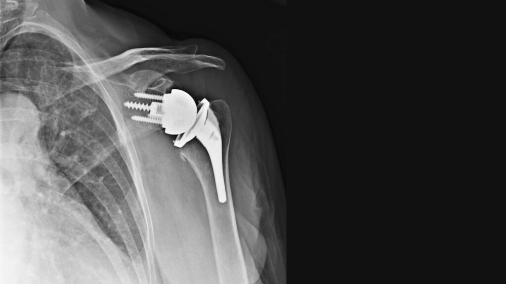 X-ray of Reverse Shoulder Replacement​