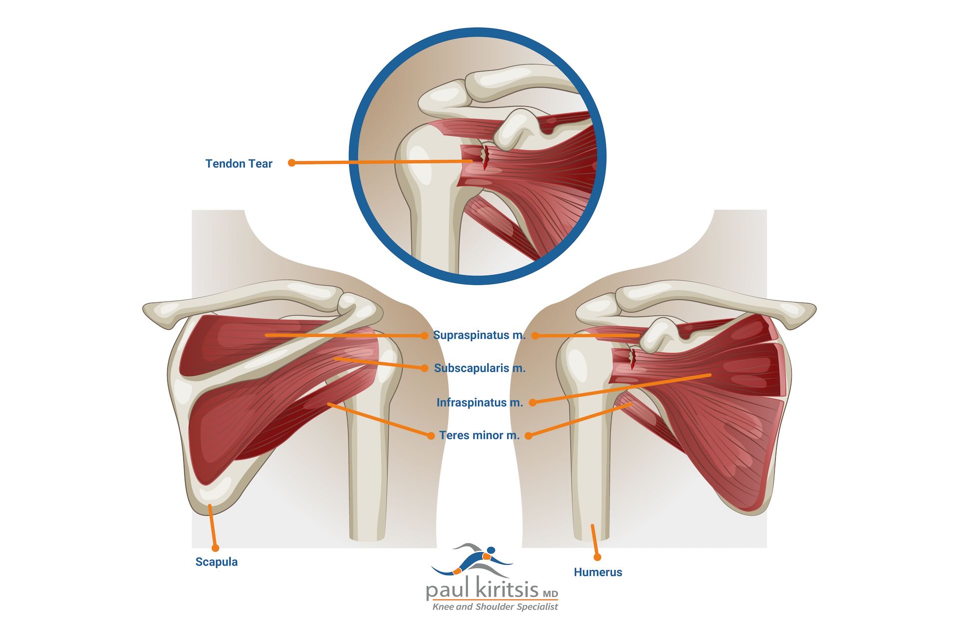 Paul Kiritsis, Anatomy of Rotator Cuff Tear