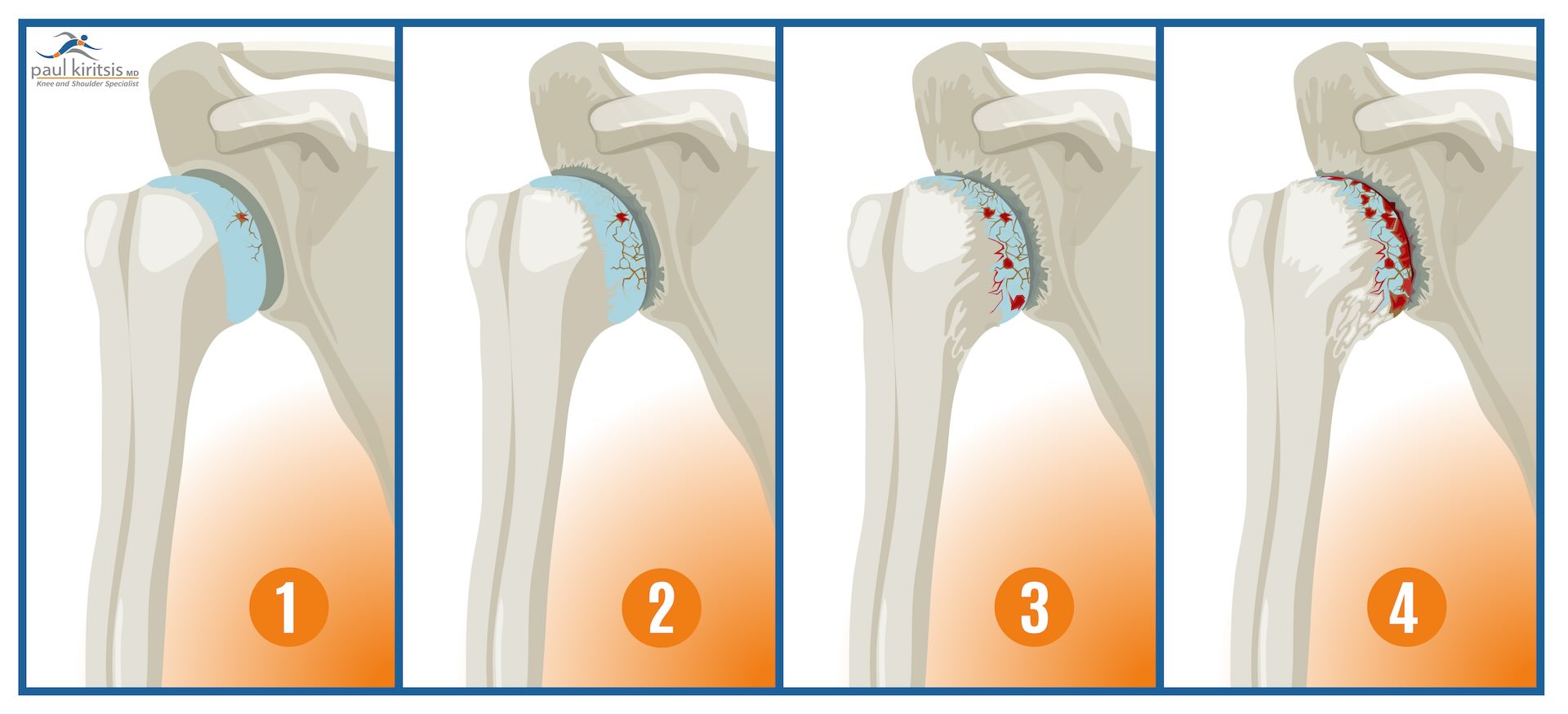 Osteoarthritis can lead to total shoulder replacement