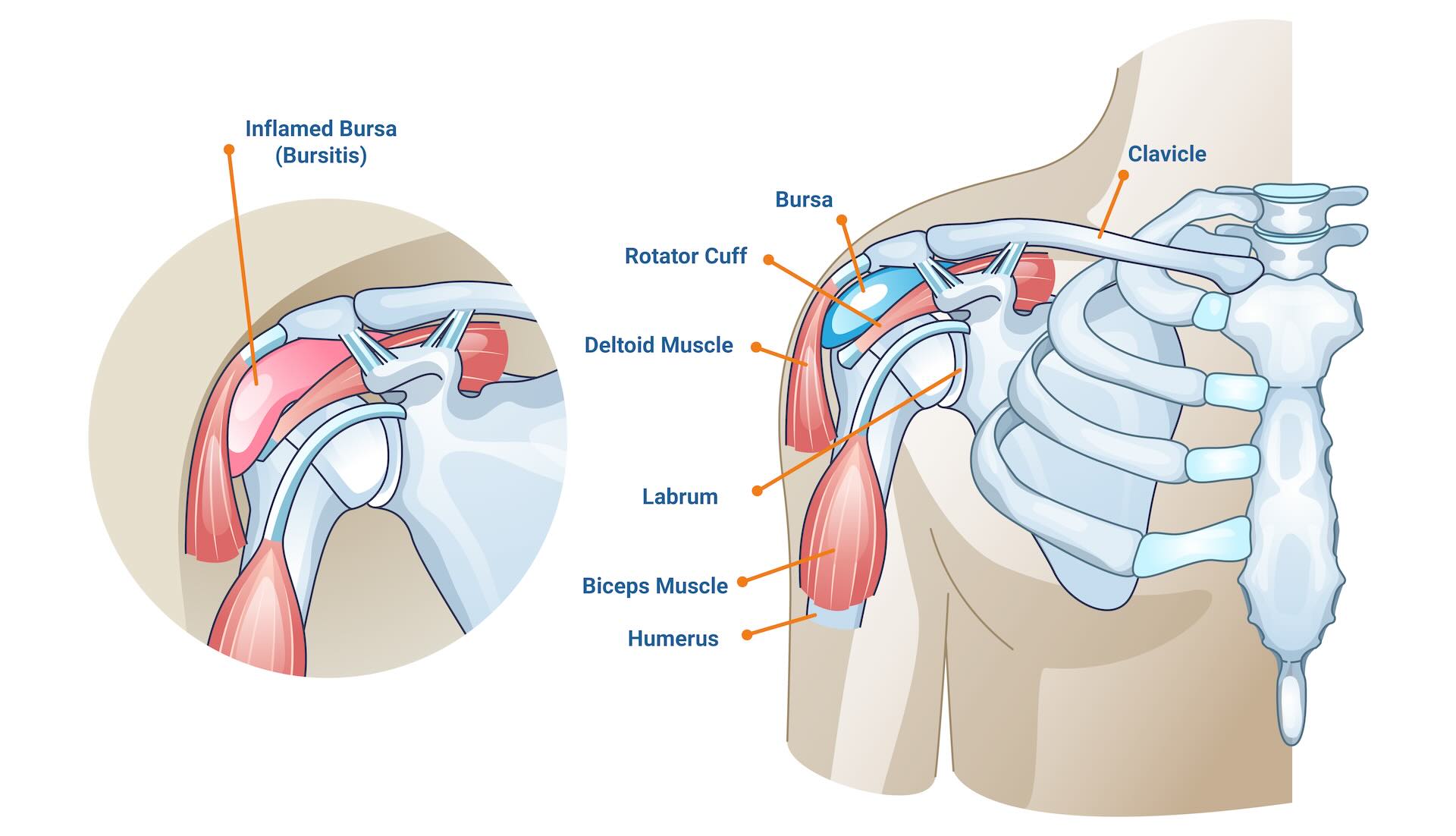 Shoulder Bursitis can lead to a reverse shoulder replacement