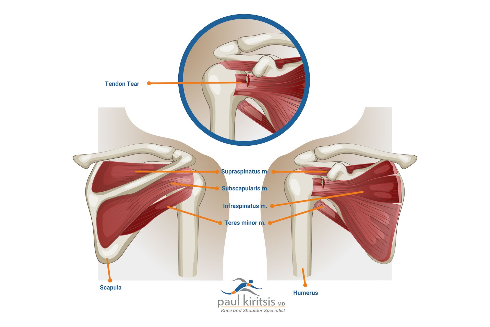 Anatomical Graphic of Rotator Cuff Tear