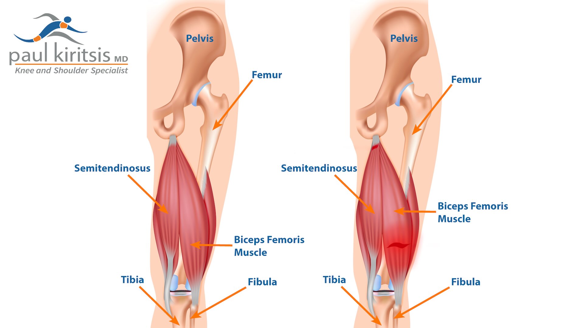 Can A Hamstring Injury Cause Knee Pain? Learn more about the symptoms, causes, and treatments.