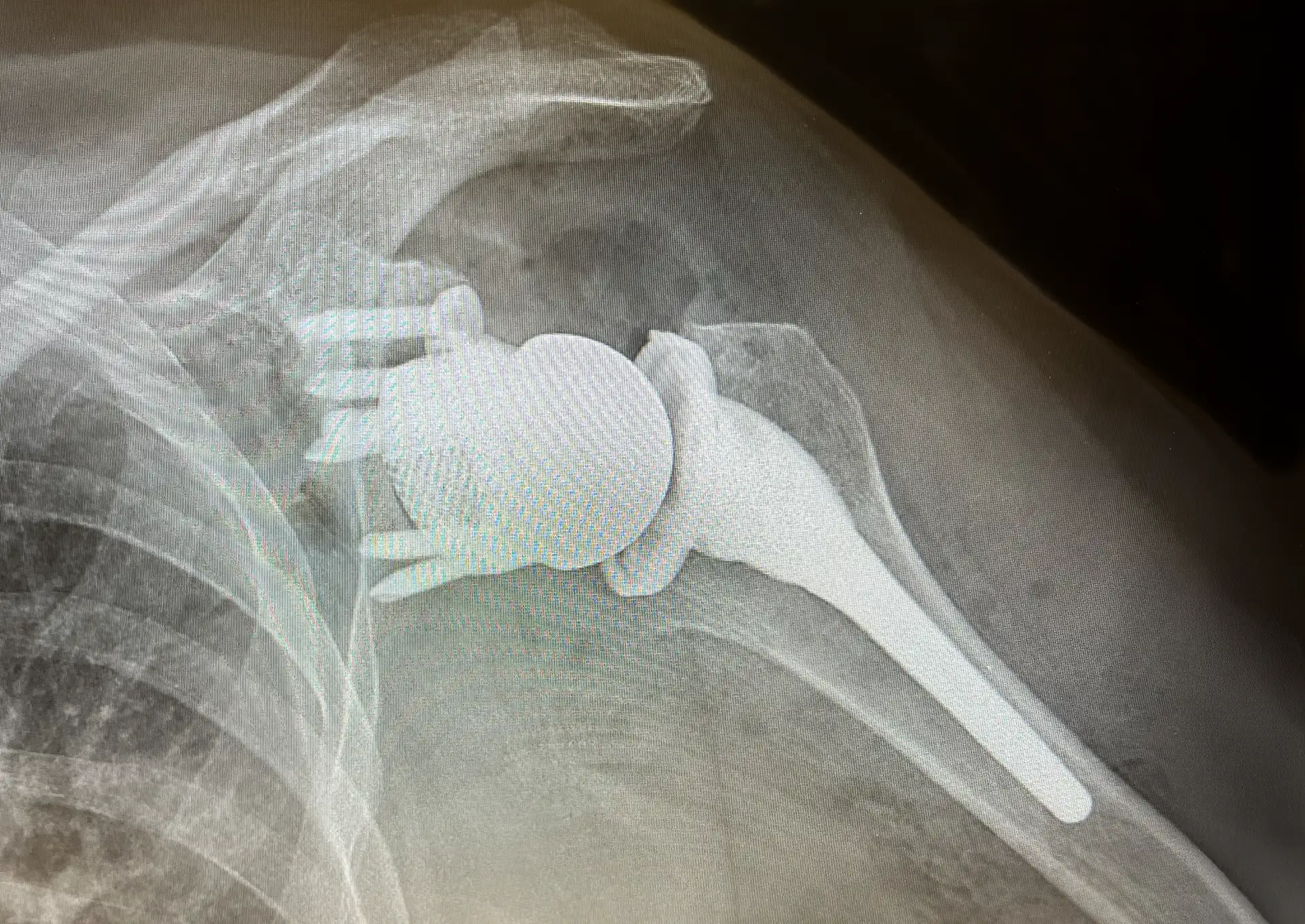 When Are Custom Shoulder Implants Required?