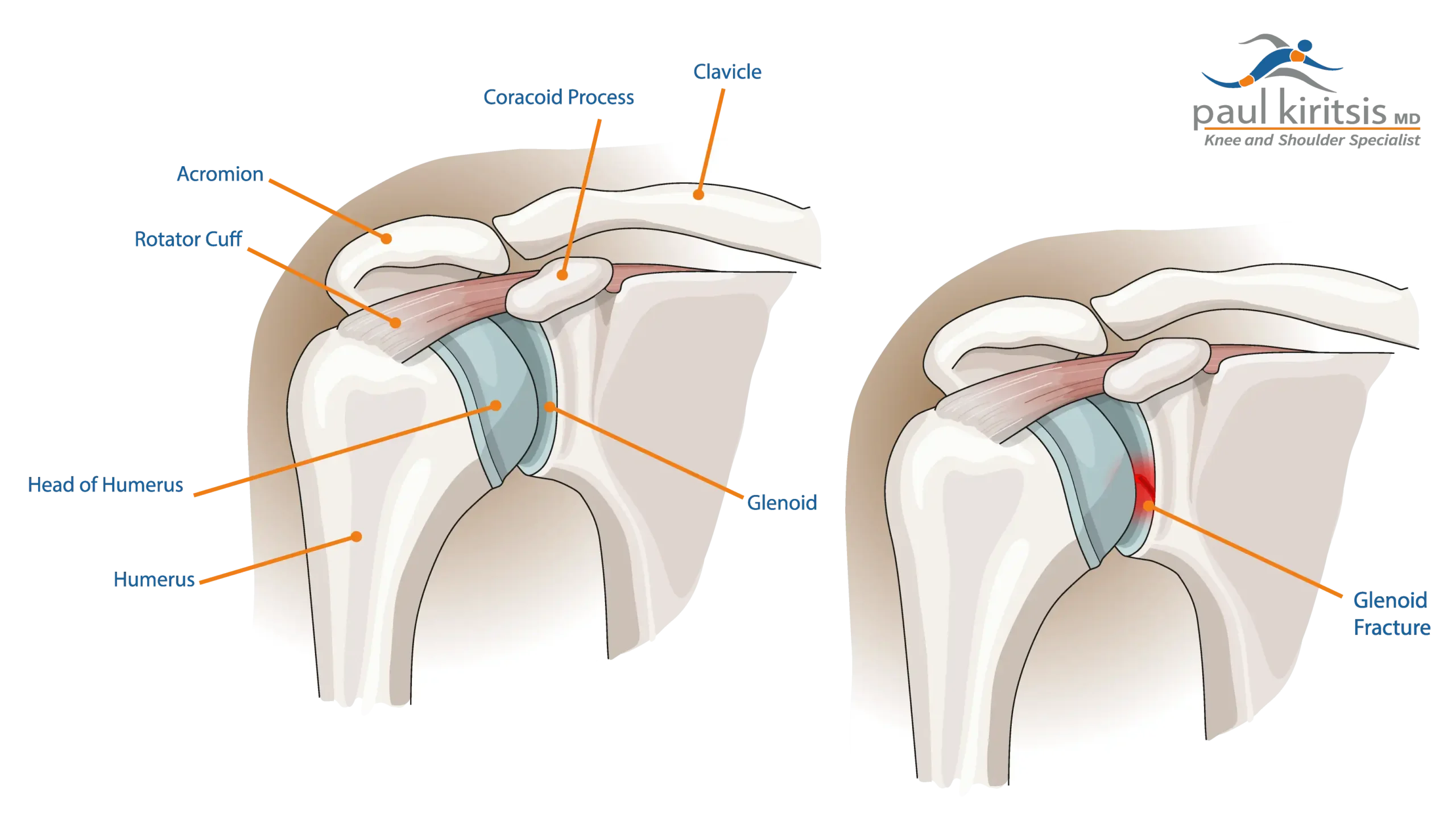 Glenoid Fracture