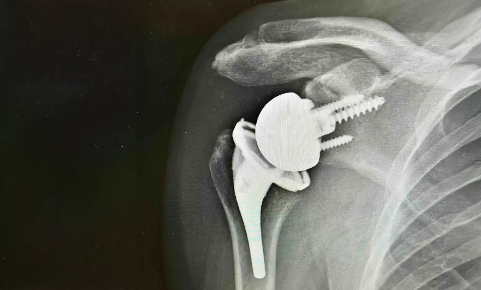 Reverse Total Shoulder Surgery X-ray