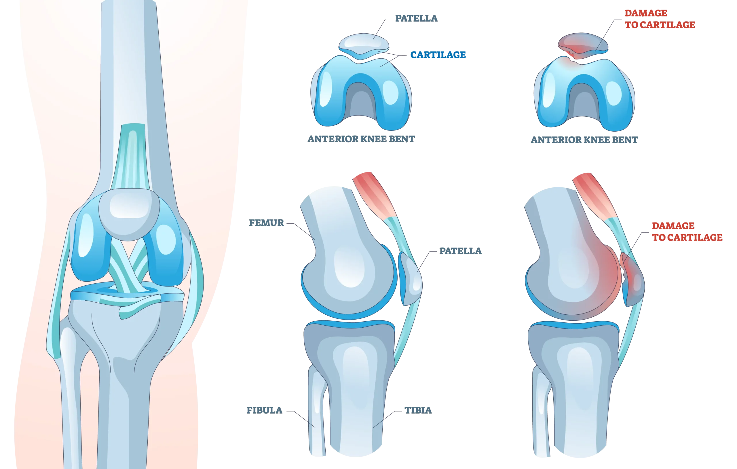 Anatomical Graphic of Chondromalacia Patella