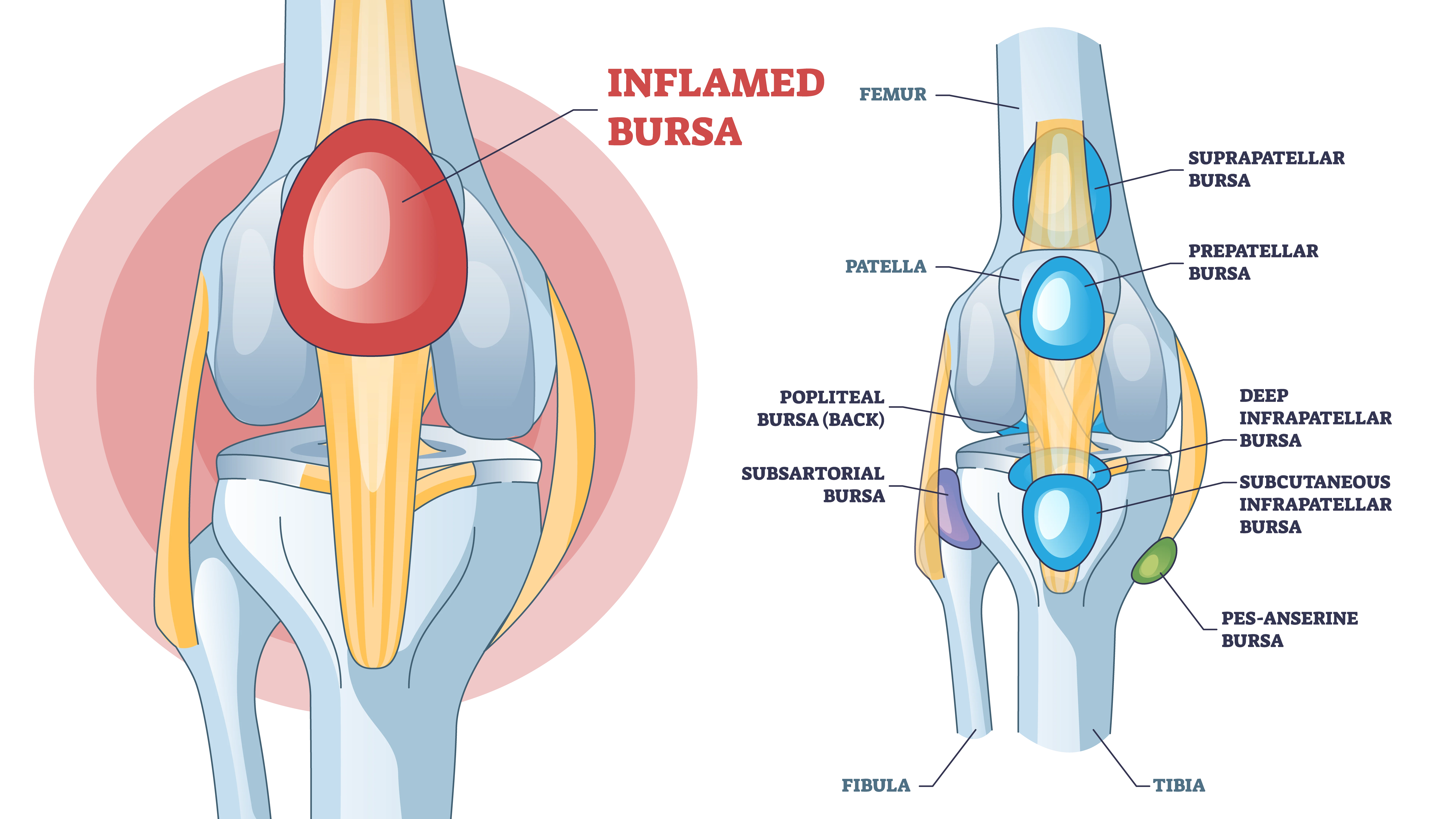 Knee Bursitis