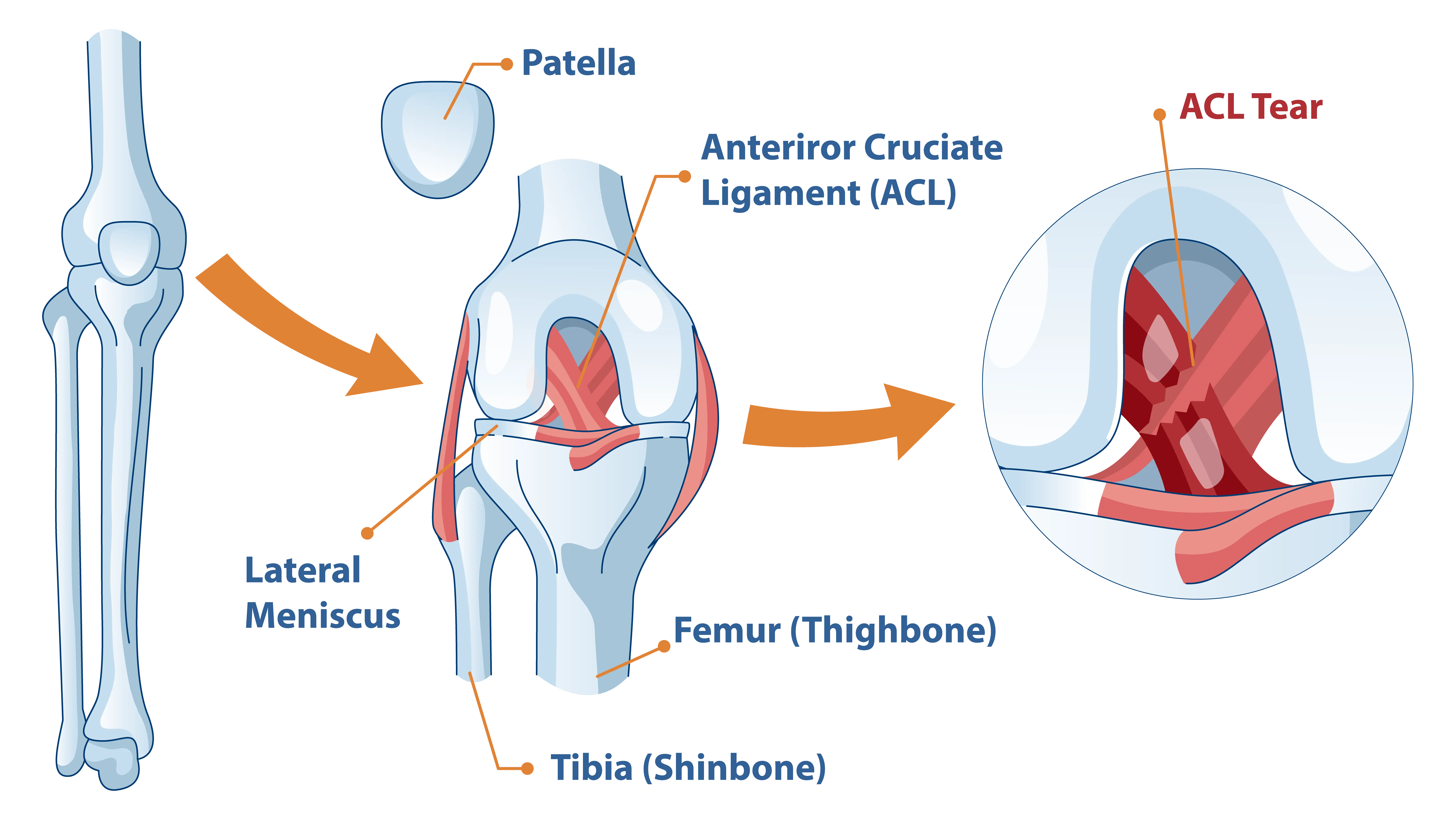 Anatomical graphic of ACL tear anatomy