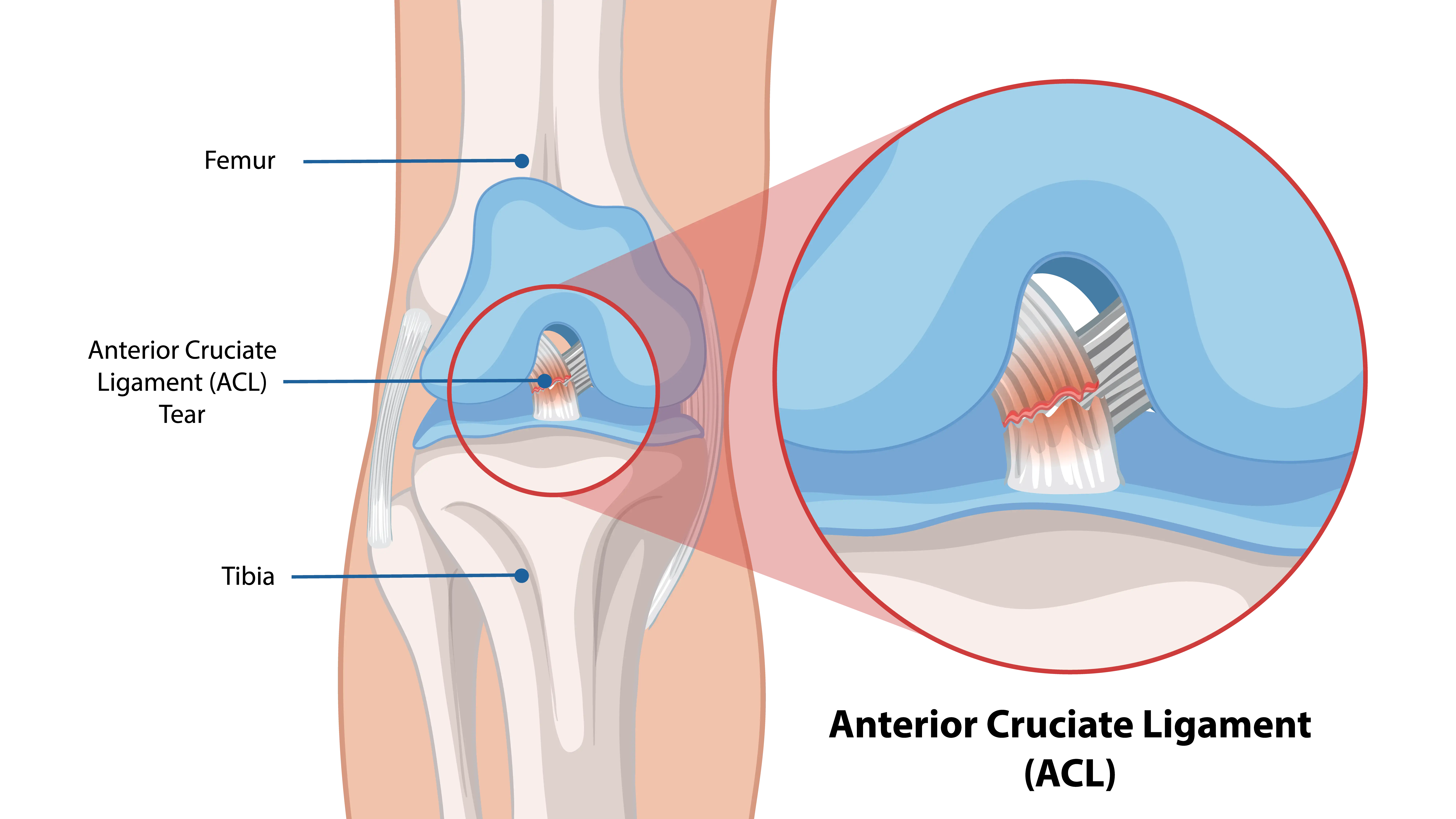 Anatomical Graphic of Torn ACL