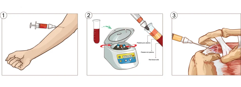 Simplified steps for using PRP for a torn rotator cuff
