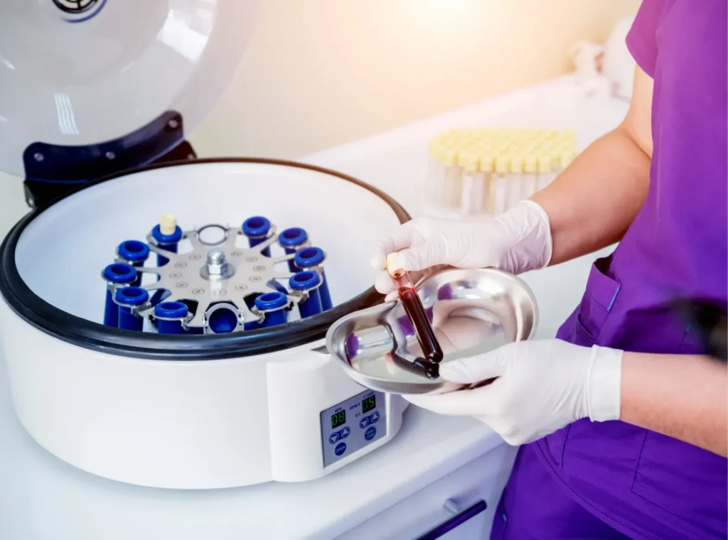 A patient's blood that has been placed into a centrifuge, a machine that spins at high speed to separate its components, concentrating the platelets into the plasma.