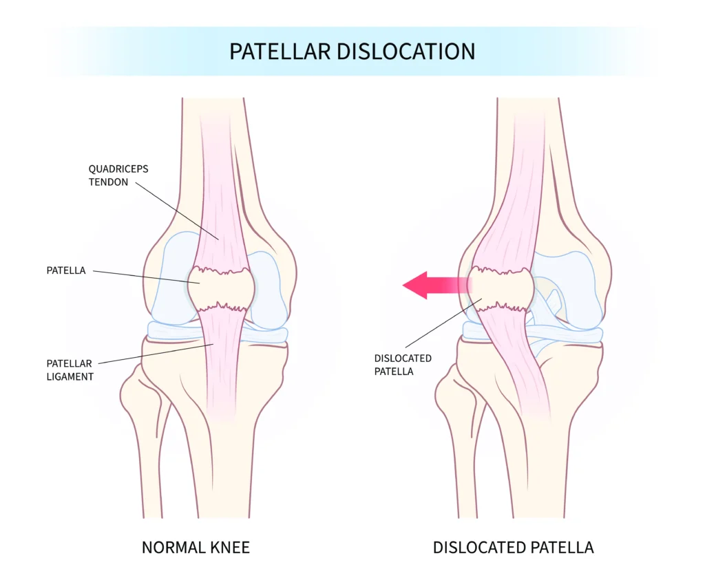 patellar dislocation diagram