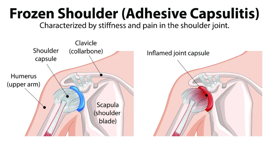 Frozen shoulder diagram, comparison between a healthy and an inflamed frozen shoulder.