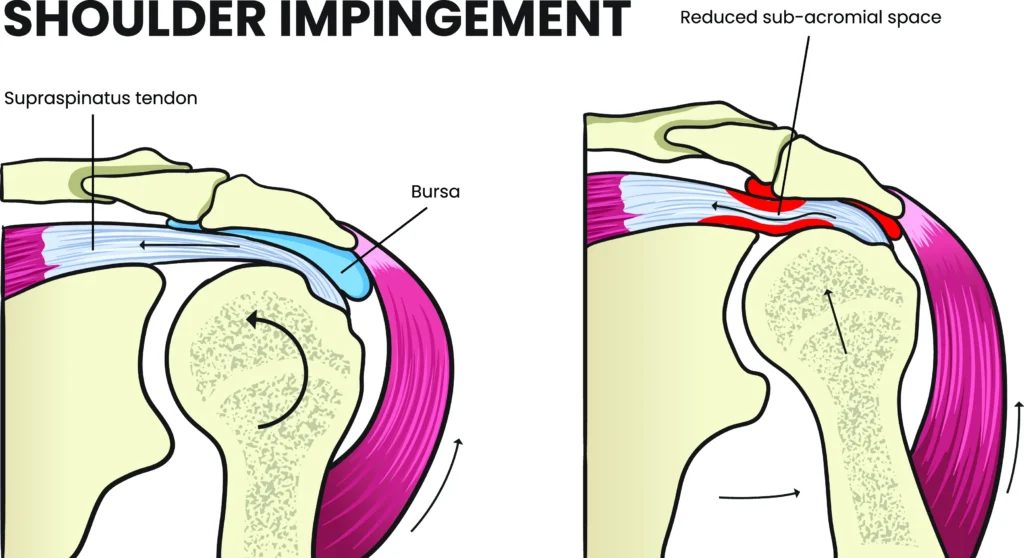 shoulder impingement diagram
