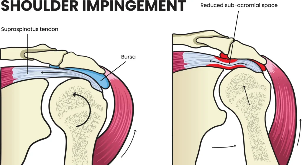 shoulder impingement diagram shoulder impingement diagram, focusing on the difference between a healthy supraspinatus tendon and a tendon with sub-acromial space.