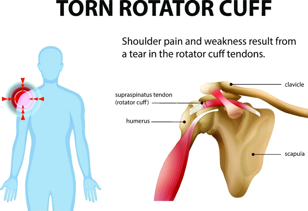 torn rotator cuff diagram